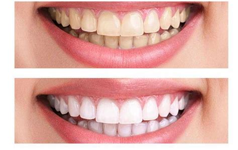 Magical White Teeth Brightening on a Budget: DIY Methods that Really Work